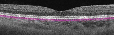 Quantitative assessment of the choroidal vasculature in myopic macular degeneration with optical coherence tomographic angiography